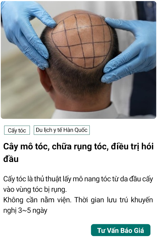 dịch vu cây tóc điều trị hói tại hàn quốc